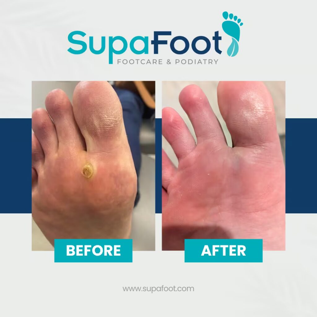 SWIFT verruca treatments 3 image2 2