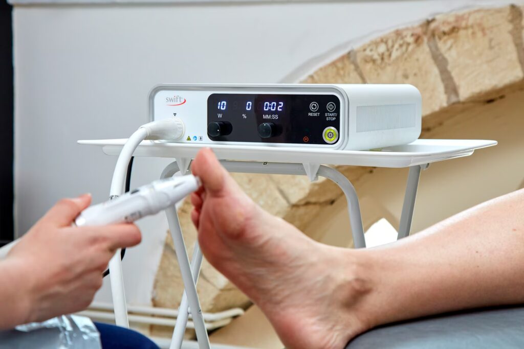 SWIFT verruca treatments 24 SWIFT Verruca Treatments Cheltenham