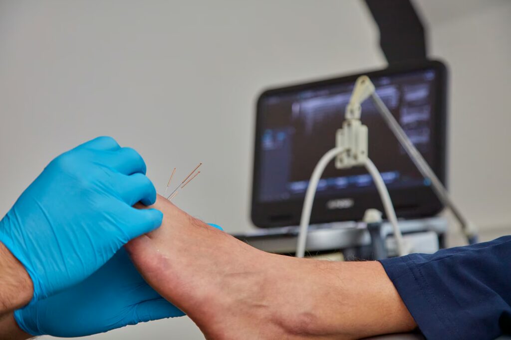 Dry needling / Acupuncture 7 Supafoot 0F7A3665